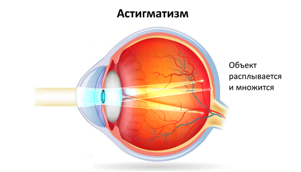 Сложный гиперметропический астигматизм глаз