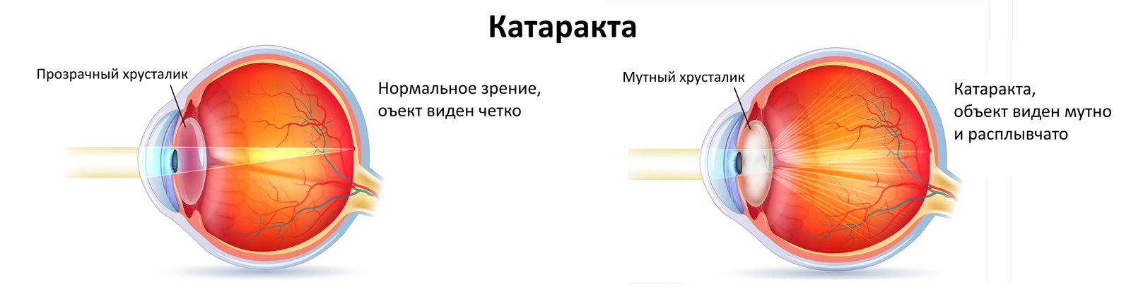 Хрусталик глаза перевод. Катаракта хрусталик строение. Катаракта схема глаза. Строение глаза человека катаракта. Строение глаза при катаракте.