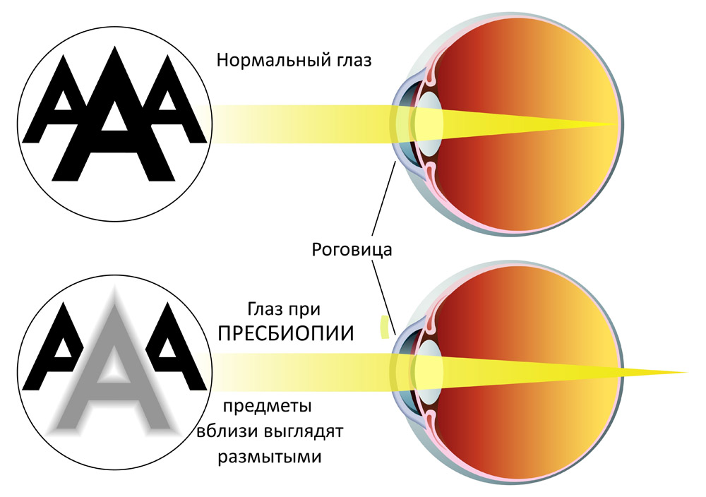 Пресбиопия глаз что это такое. Сложный миопический астигматизм обоих глаз. Близорукость миопия. Зрение при близорукости. Миопин.