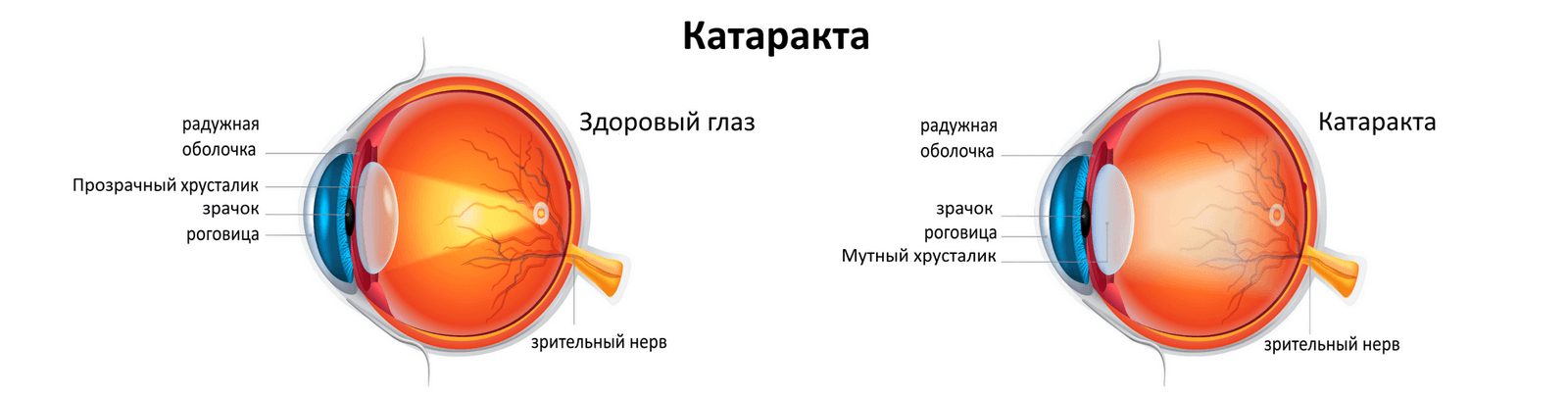 Катаракта схема